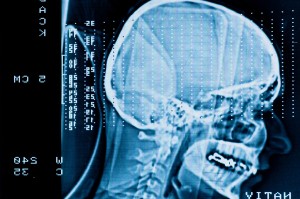 San Francisco Brain Injury Lawyer